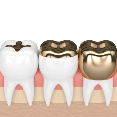 Gold Crown - Image 2