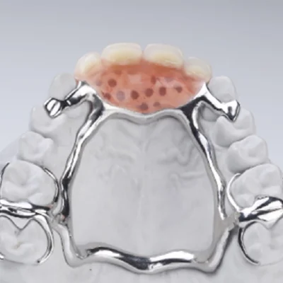 Metallic Denture (1 Jaw) - Image 2