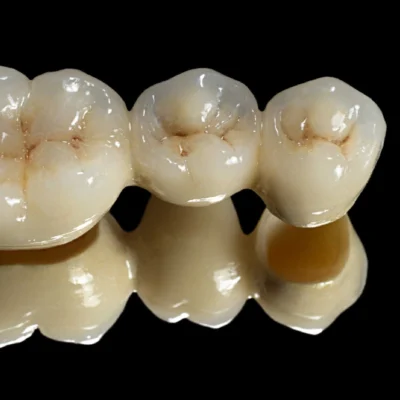 Porcelain Crown and Bridge - Image 2