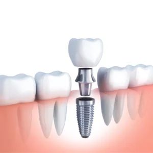 Dental Implants (Per Unit)