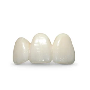 IPS e.max Press Crown