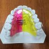Removal Ortho