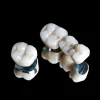 Porcelain Crown and Bridge