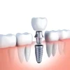 Dental Implants (Per Unit)